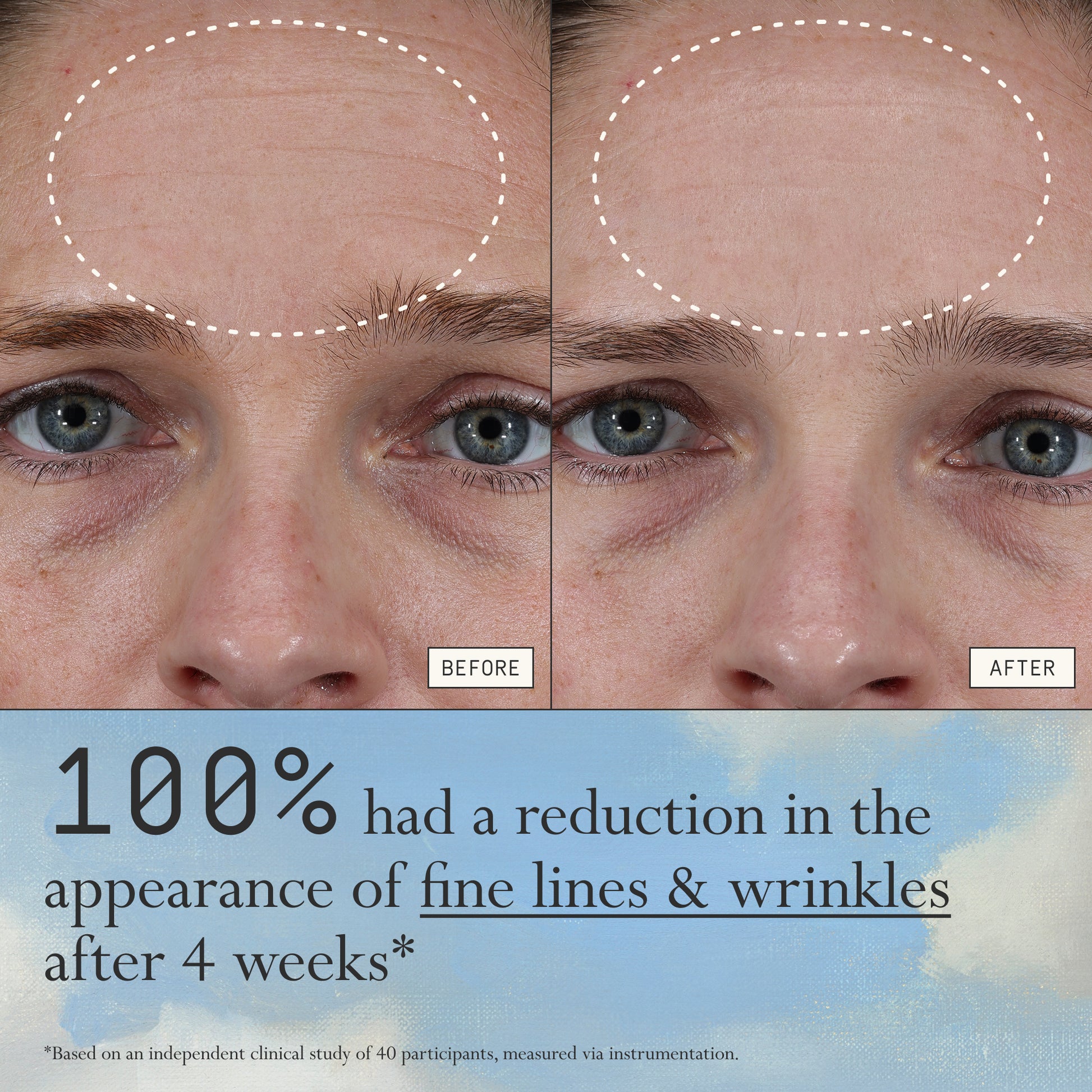 Before and after comparison of fine lines and wrinkles from using Dieux Instant Angel on a person's forehead.
Text: 100% had a reduction in the appearance of fine lines & wrinkles after 4 weeks*
*based on an independent clinical study of 40 participants, measured via instrumentation"