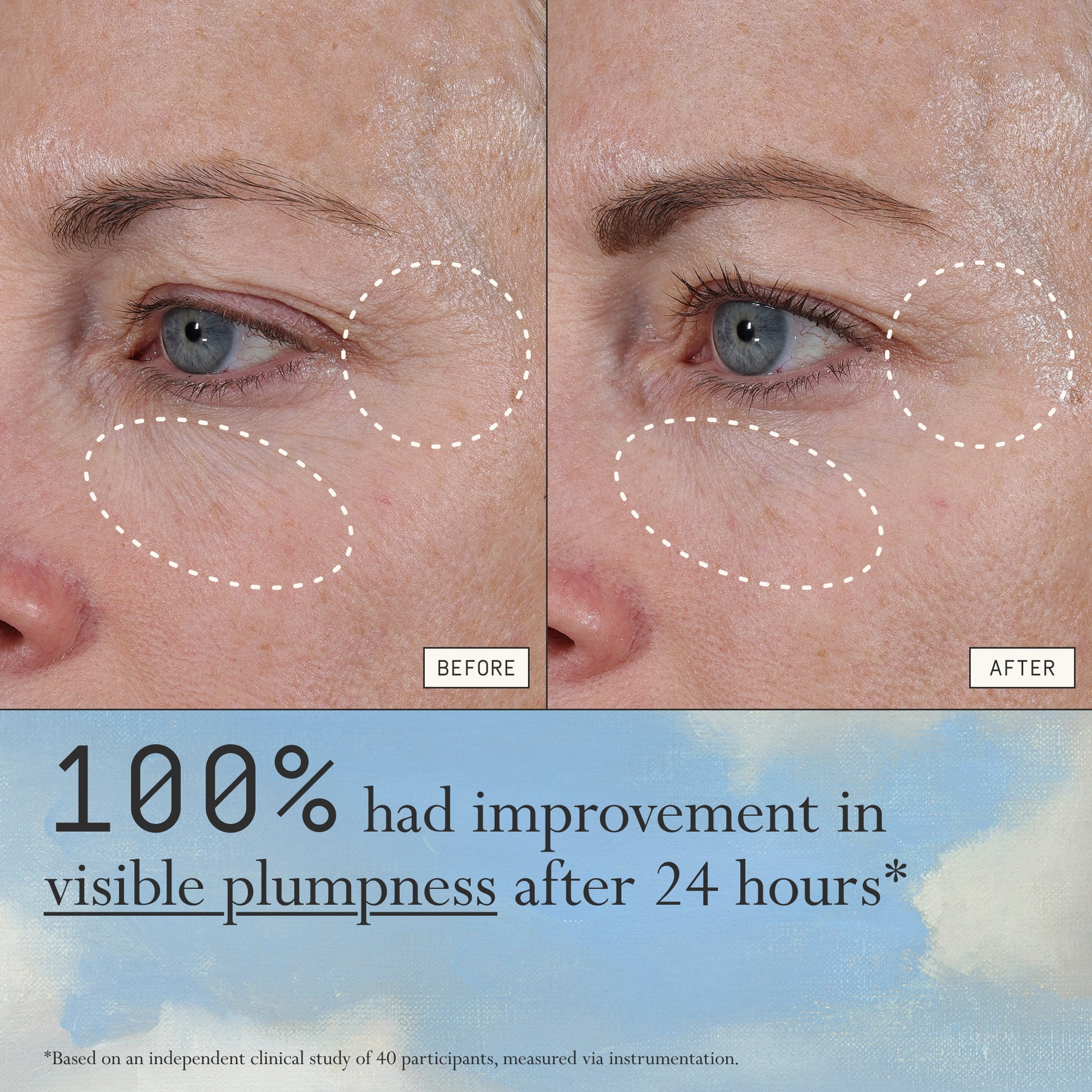 Before and after comparison of fine lines and wrinkles from using Dieux Instant Angel on a person's eye area.
Text: 100% had improvement in visible plumpness after 24 hours*
*based on an independent clinical study of 40 participants, measured via instrumentation