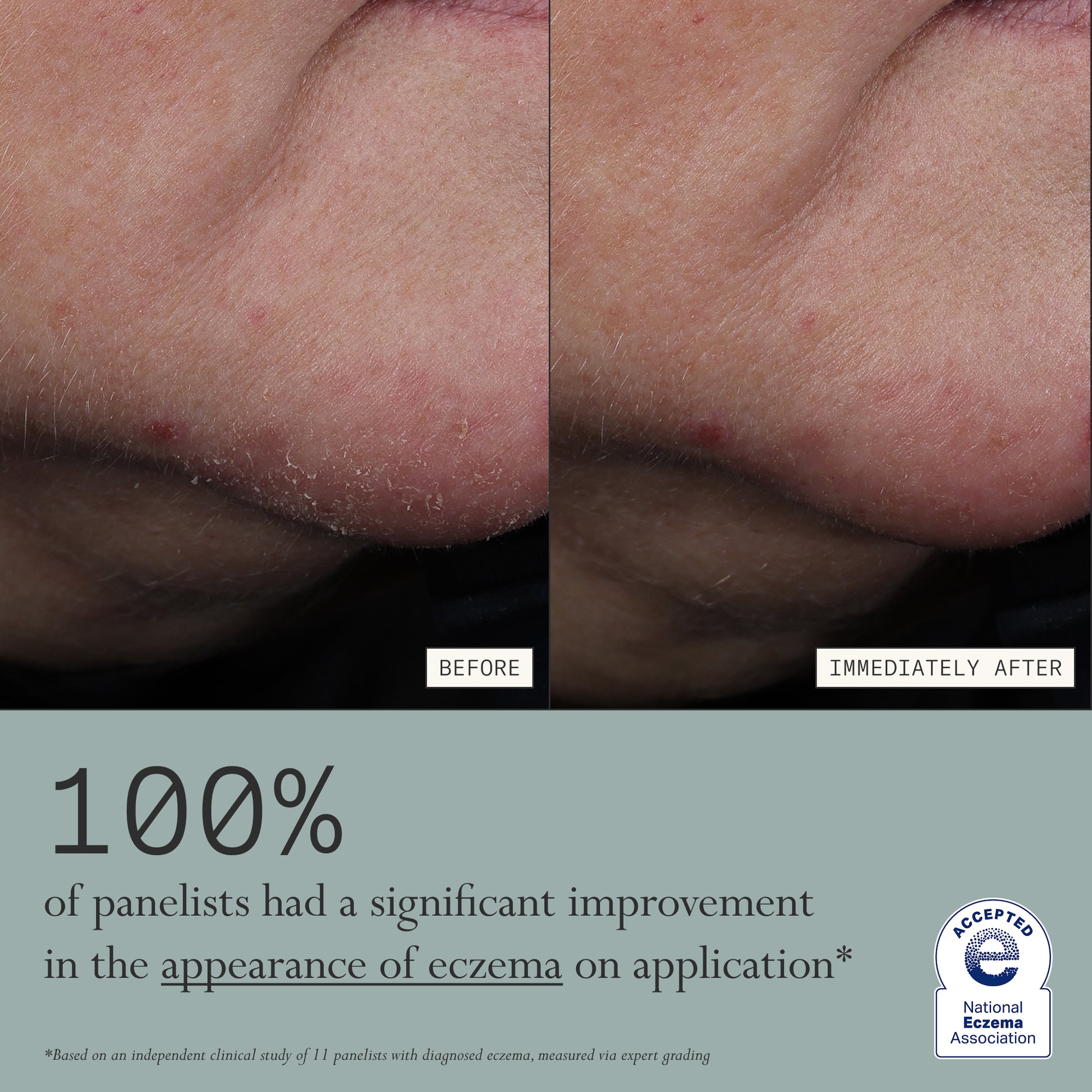 Before and after comparison of eczema on skin with text about improvement, before and after using Dieux's Skin Mercy Recovery Cream