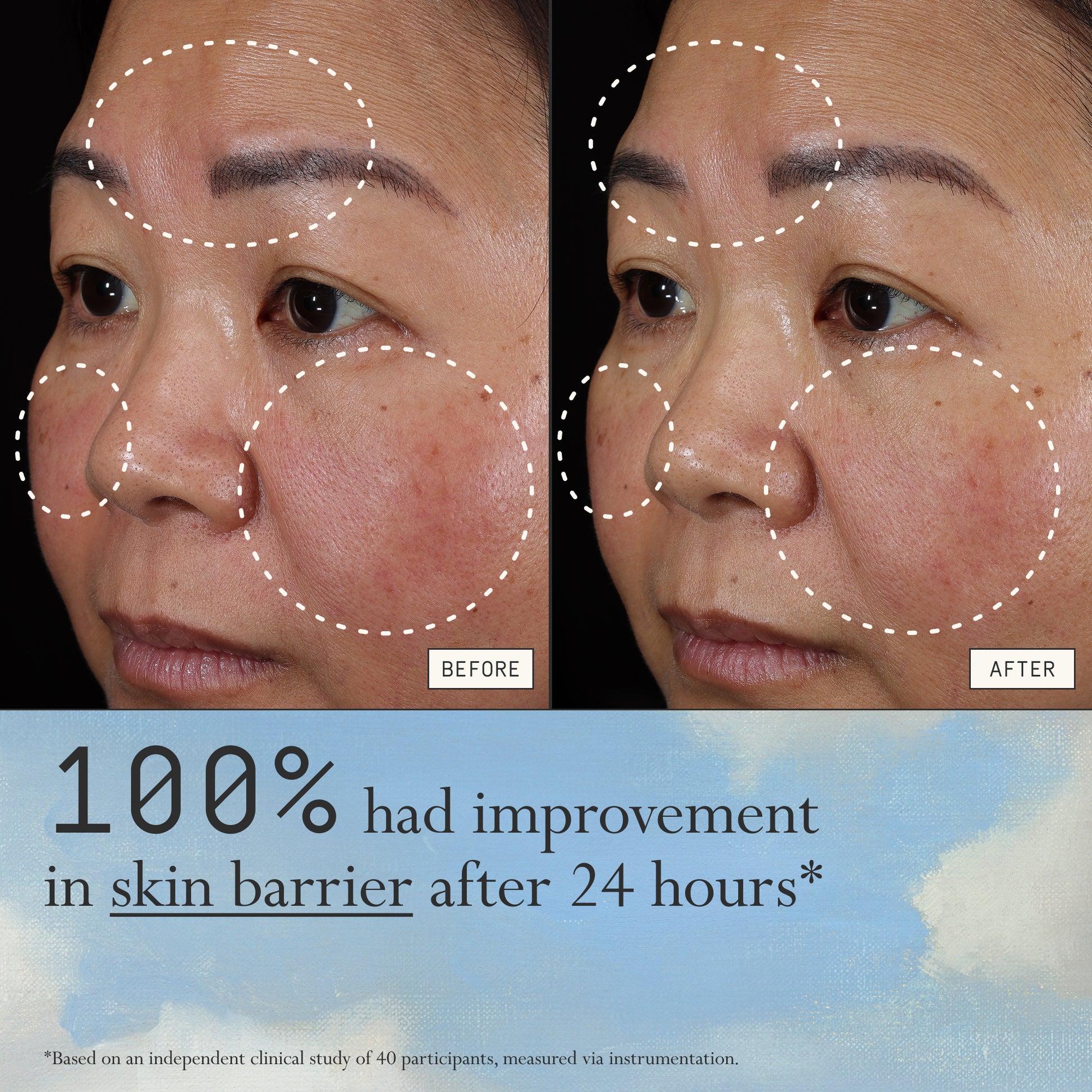 Before and after comparison of redness from using Dieux Instant Angel on a person's face.
Text: 100% had improvement in skin barrier after 24 hours*
*based on an independent clinical study of 40 participants, measured via instrumentation