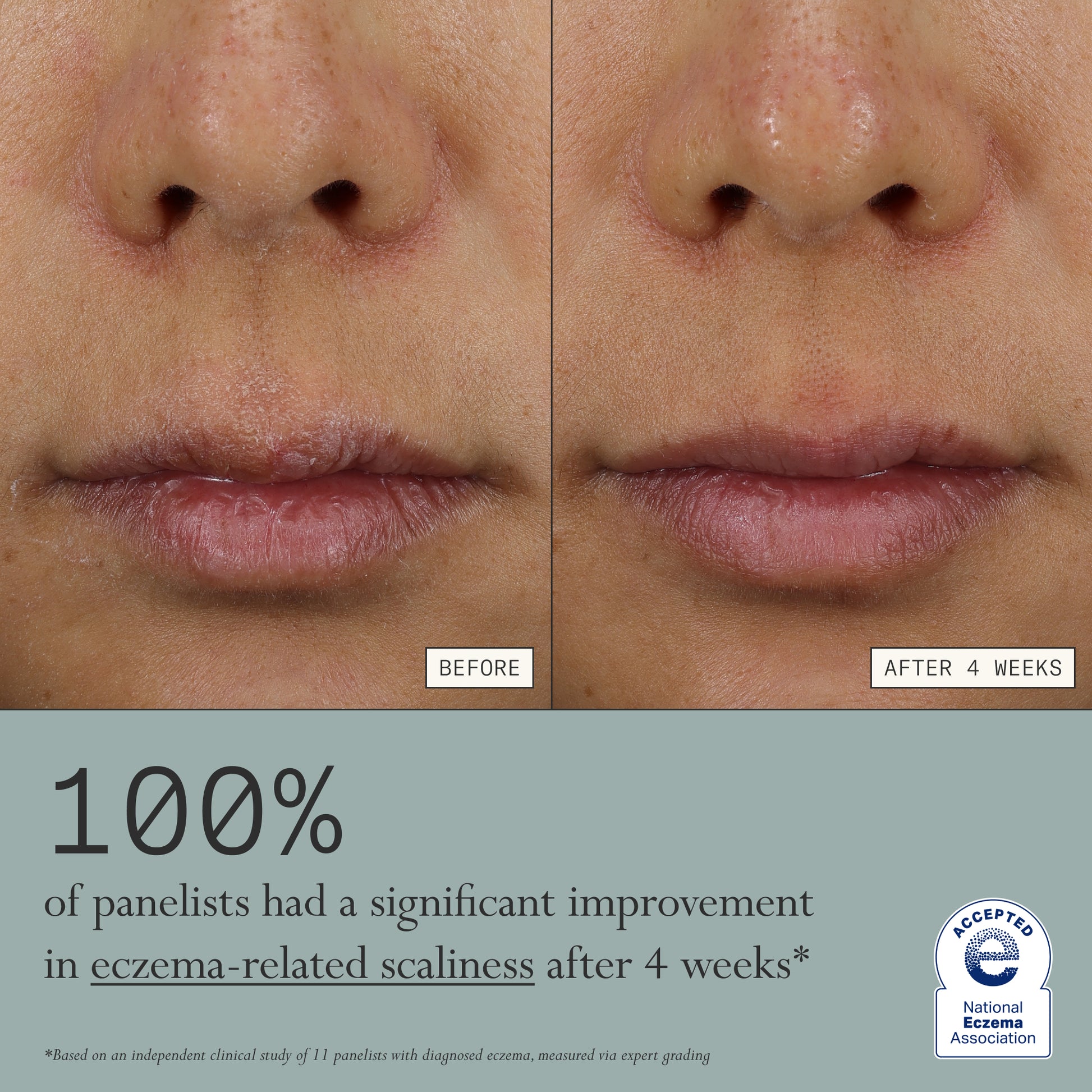 Before and after comparison of eczema-related scaliness on a person's face with text indicating improvement after 4 weeks after using Dieux's Skin Mercy Recovery Cream