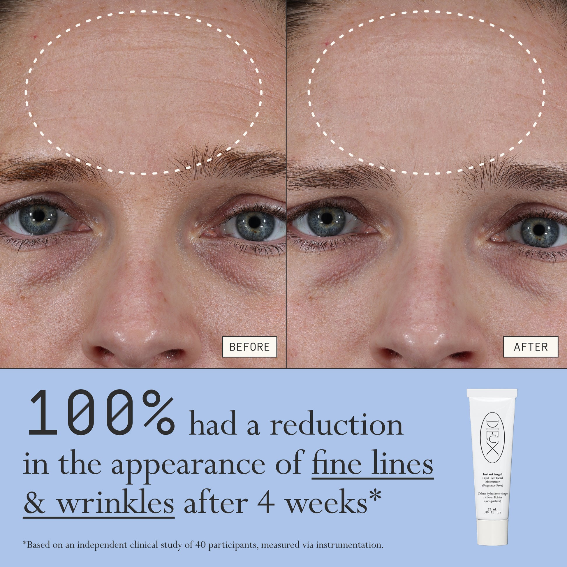 Before and after comparison of fine lines and wrinkles from using Dieux Instant Angel on a person's forehead.
Text: 100% had a reduction in the appearance of fine lines & wrinkles after 4 weeks*
*based on an independent clinical study of 40 participants, measured via instrumentation.