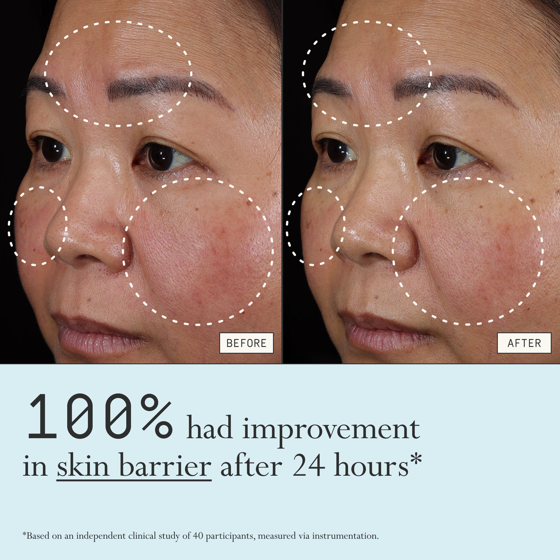 Before and after comparison of redness from using Dieux Instant Angel on a person's face.
Text: 100% had improvement in skin barrier after 24 hours*
*based on an independent clinical study of 40 participants, measured via instrumentation.