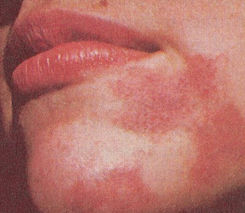 Eczema, Decoded: What It Is, What Causes It, and How to Treat It