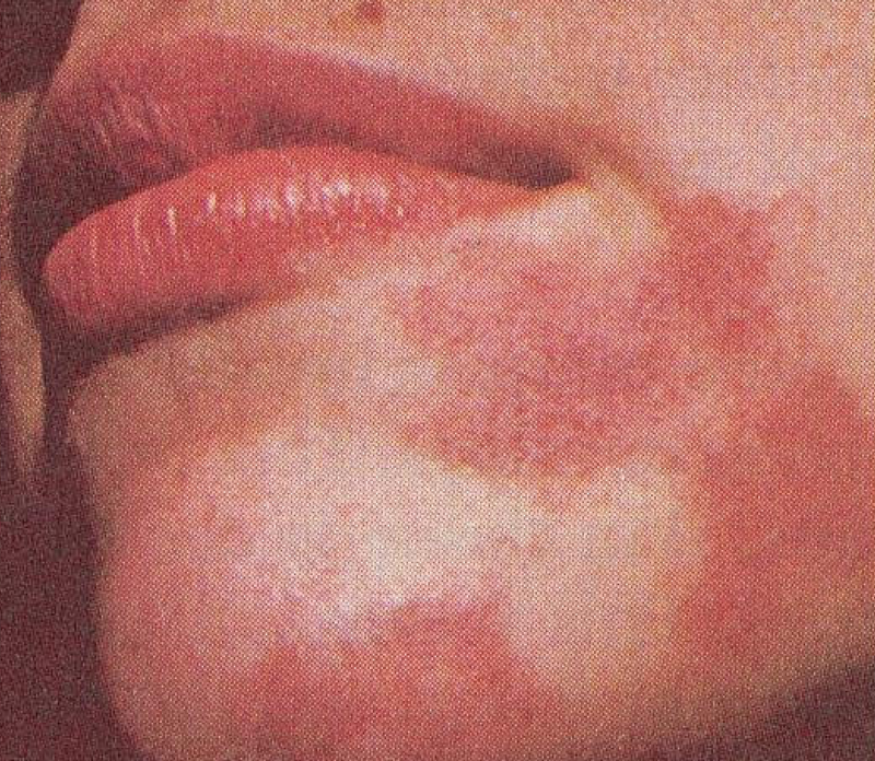 Eczema, Decoded: What It Is, What Causes It, and How to Treat It