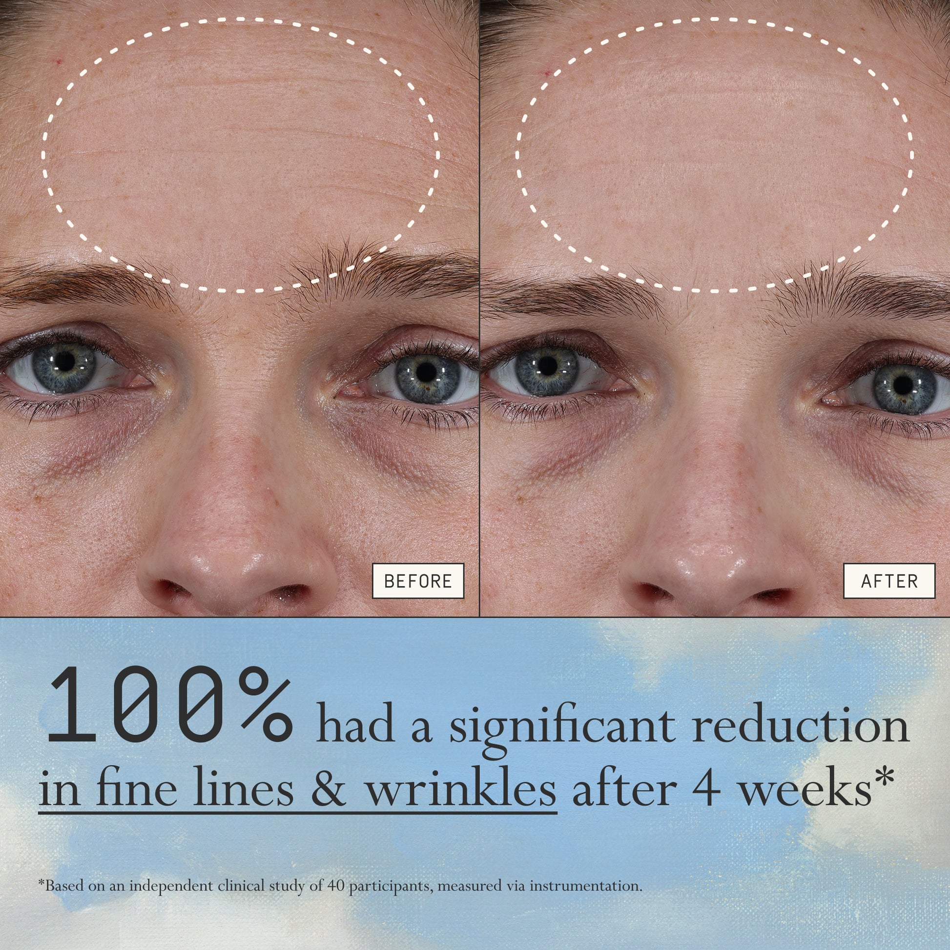Before and after comparison of fine lines and wrinkles from using Dieux Instant Angel on a person's forehead.

Text: 100% had a significant reduction in fine lines & wrinkles after 4 weeks*

*based on an independent clinical study of 40 participants, measured via instrumentation