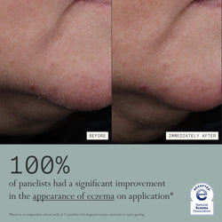 Before and after comparison of eczema on skin with text about improvement, before and after using Dieux's Skin Mercy Recovery Cream