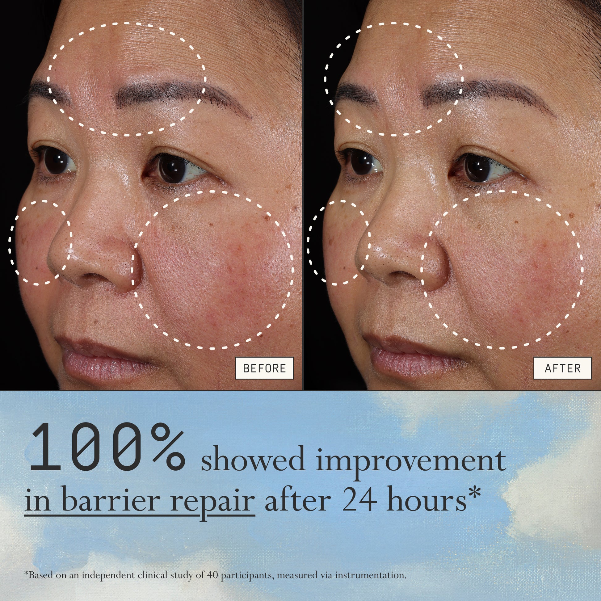 Before and after comparison of hyperpigmentation and redness from using Dieux Instant Angel on a person's face.

Text: 100% showed improvements in skin barrier repair in 24 hours*

*based on an independent clinical study of 40 participants, measured via instrumentation
