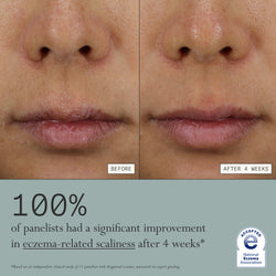 Before and after comparison of eczema-related scaliness on a person's face with text indicating improvement after 4 weeks after using Dieux's Skin Mercy Recovery Cream