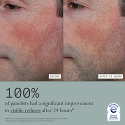 Before and after comparison of visible redness on a person's face with text indicating improvement after using Dieux's Skin Mercy Recovery Cream.