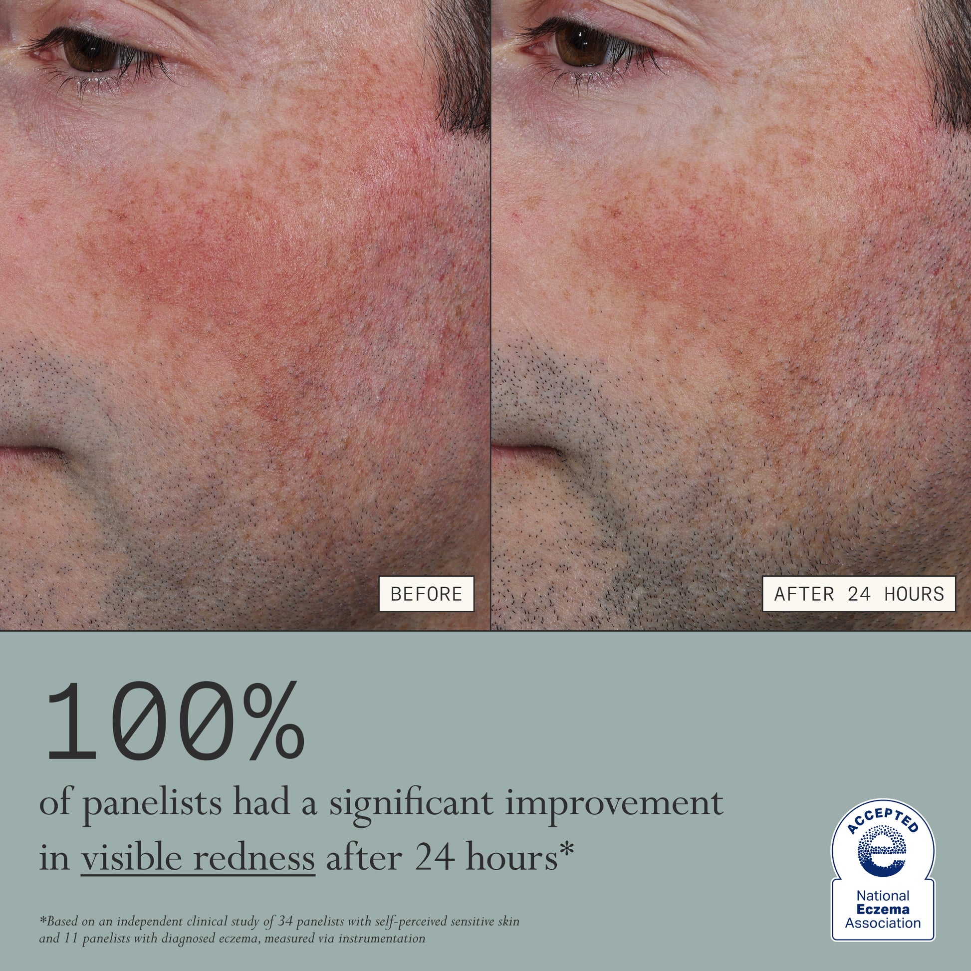 Before and after comparison of visible redness on a person's face with text indicating improvement after using Dieux's Skin Mercy Recovery Cream.
