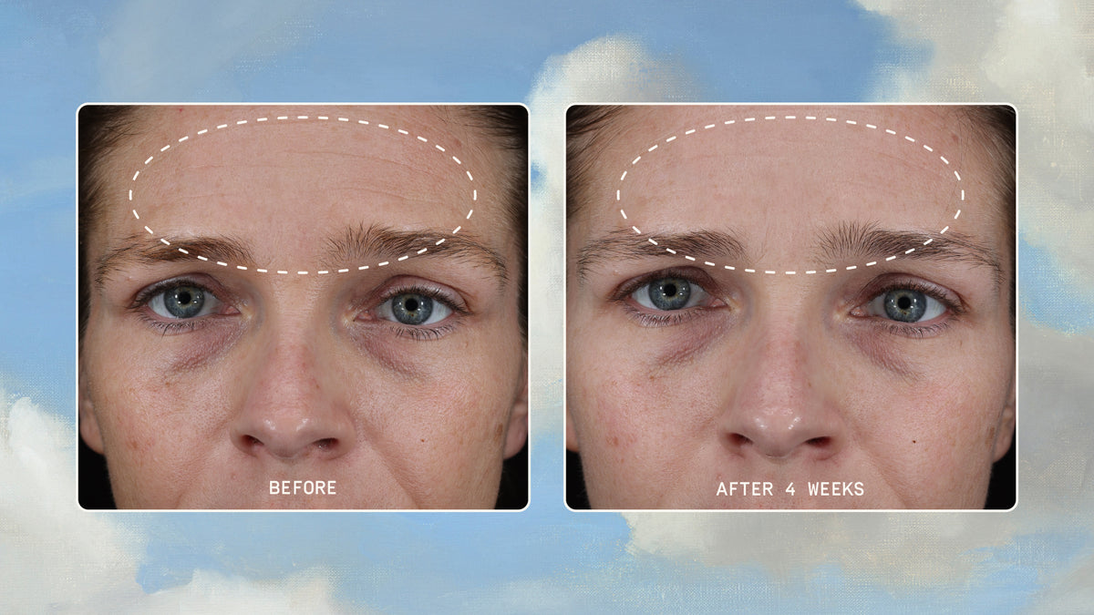 dieux Dieux-before-and-after-comparison-of-a-womans-forehead-showing-a-reduction-in-lines-after-4-weeks-of-product-use-1.