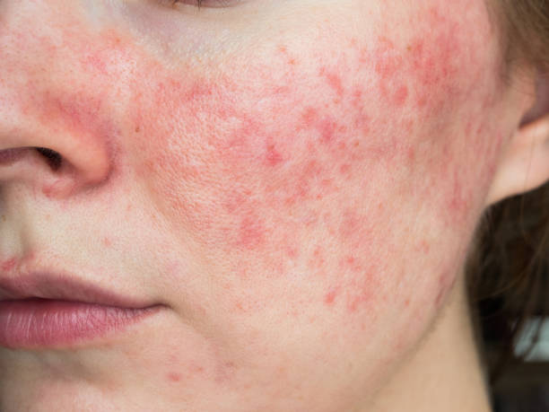 dieux Dieux-cheek-and-nose-red-irritated-skin.